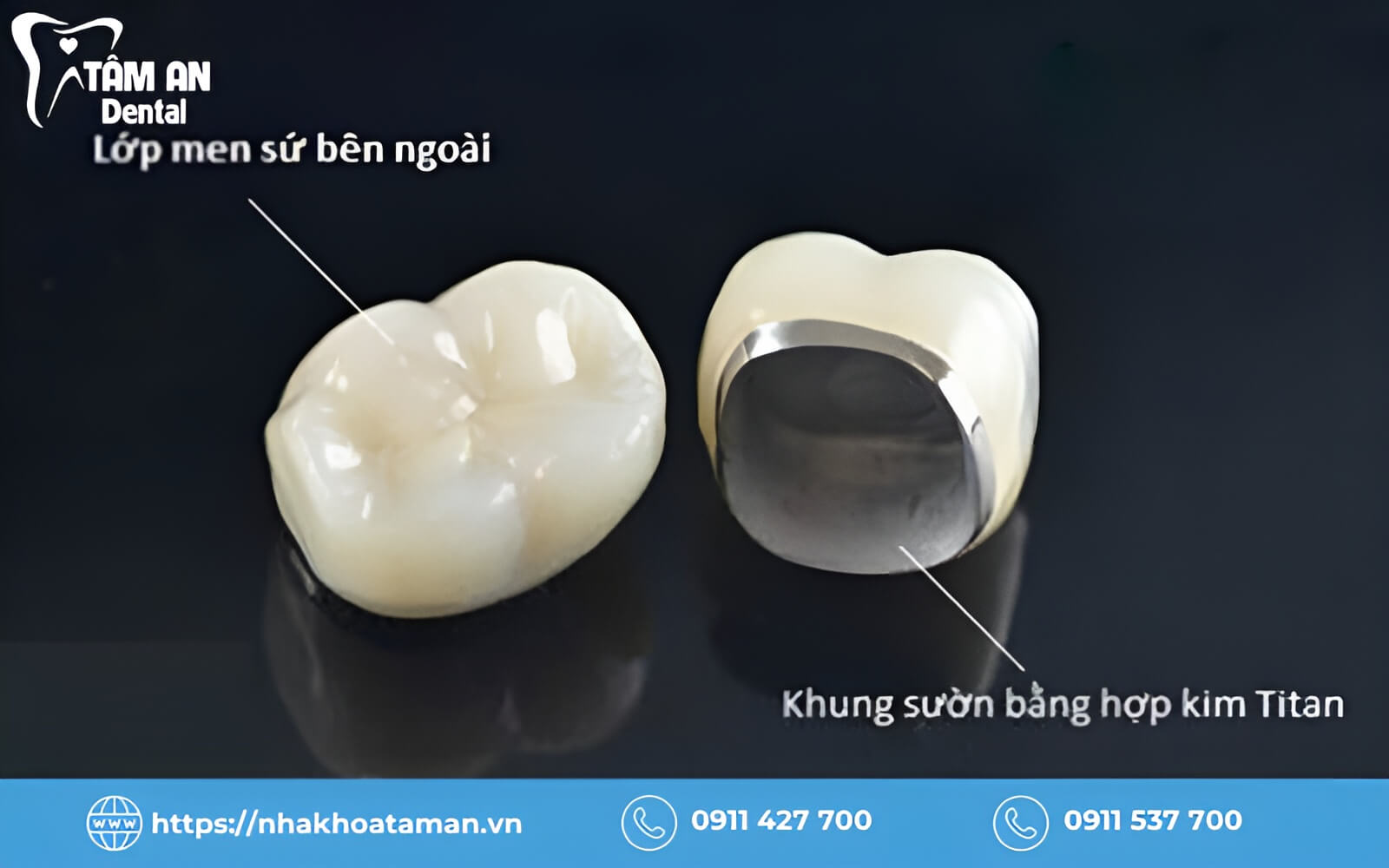 Răng sứ kim loại Titan có phần khung làm từ hợp kim Titanium