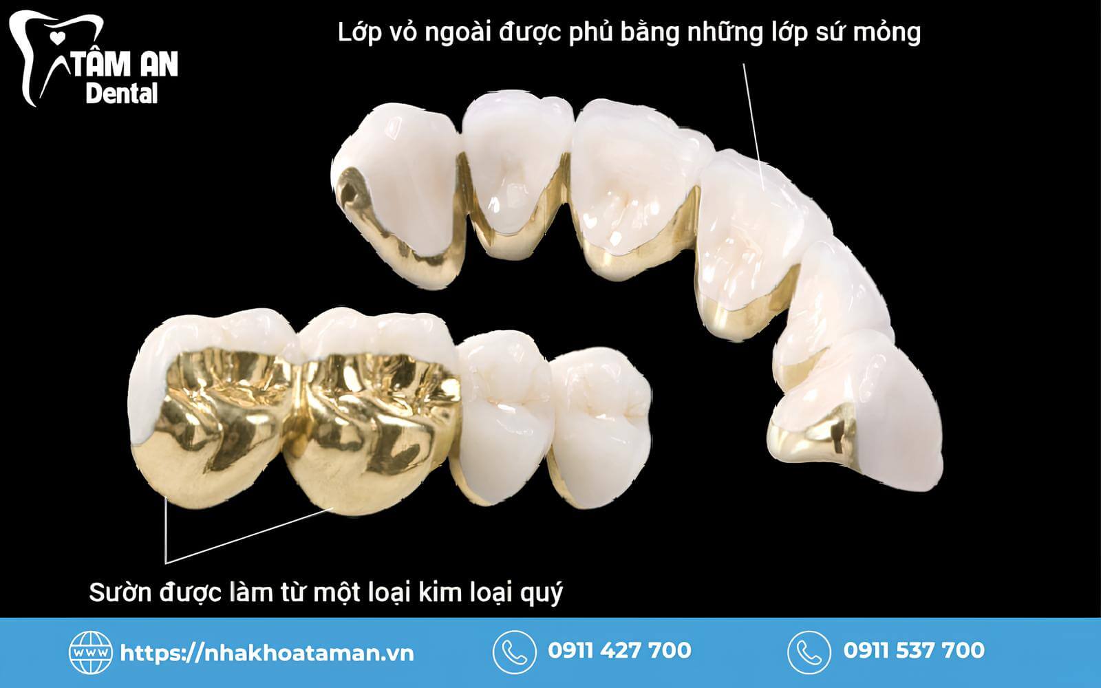 Răng sứ kim loại quý có khung làm từ các kim loại quý như vàng, bạc hoặc platinum, kết hợp với lớp sứ bên ngoài