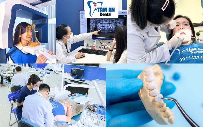 Nha Khoa Tâm An là địa chỉ bọc răng sứ uy tín hàng đầu TPHCM