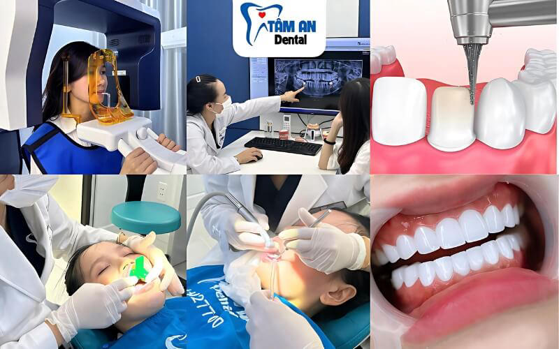 Quy trình bọc răng sứ Zirconia tại Nha Khoa Tâm An đảm bảo an toàn, hiệu quả cao