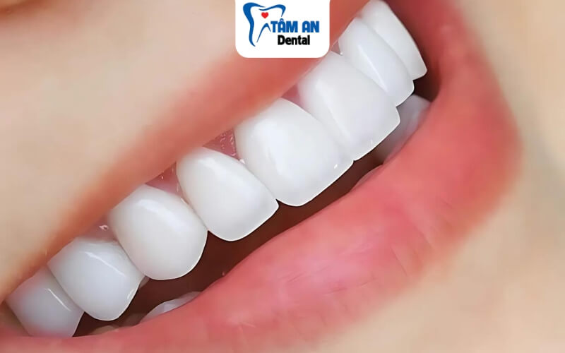 Răng sứ ngọc trai có nhiều ưu điểm nổi bật về màu sắc, độ trong bóng, độ bền và tuổi thọ cao