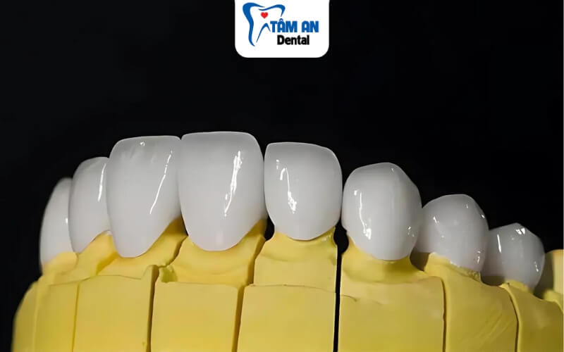 Răng sứ ngọc trai có cấu tạo gồm lớp sườn Dioxit Zirconium và lớp sứ phủ có thành phần bột ngọc trai