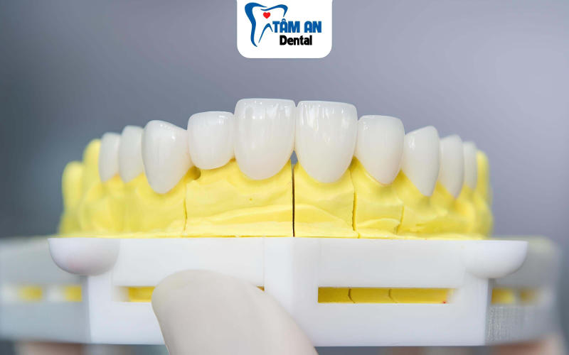 Răng sứ Zirconia là loại răng toàn sứ được chế tác từ vật liệu sứ Zirconia không kim loại