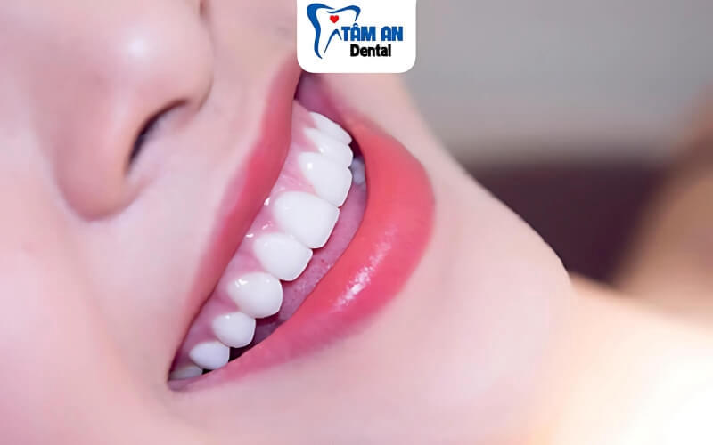 Răng sứ Zirconia phù hợp với nhiều trường hợp phục hình răng, được nhiều khách hàng yêu thích